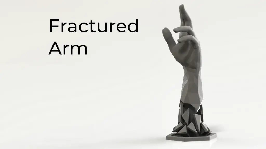 Fractured Arm